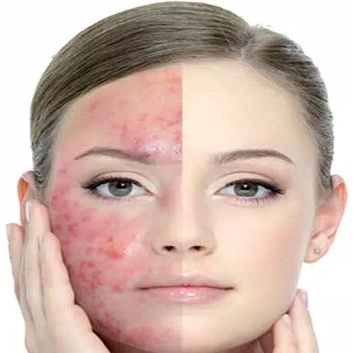 Get Rid of Acne  (Guide)應用截圖第2張